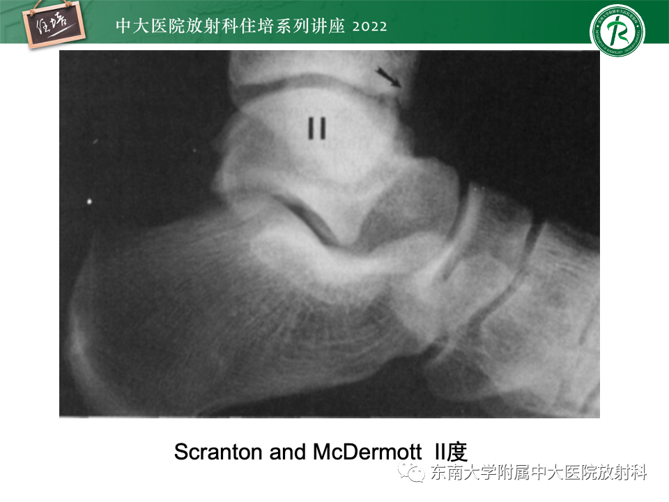 影像PPT - 【PPT】踝关节撞击综合征-12