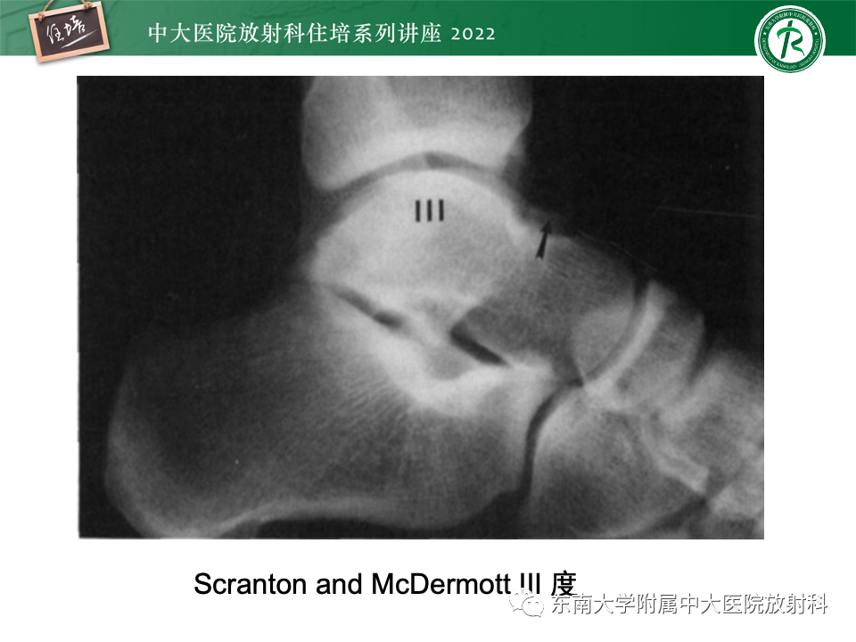 影像PPT - 【PPT】踝关节撞击综合征-13