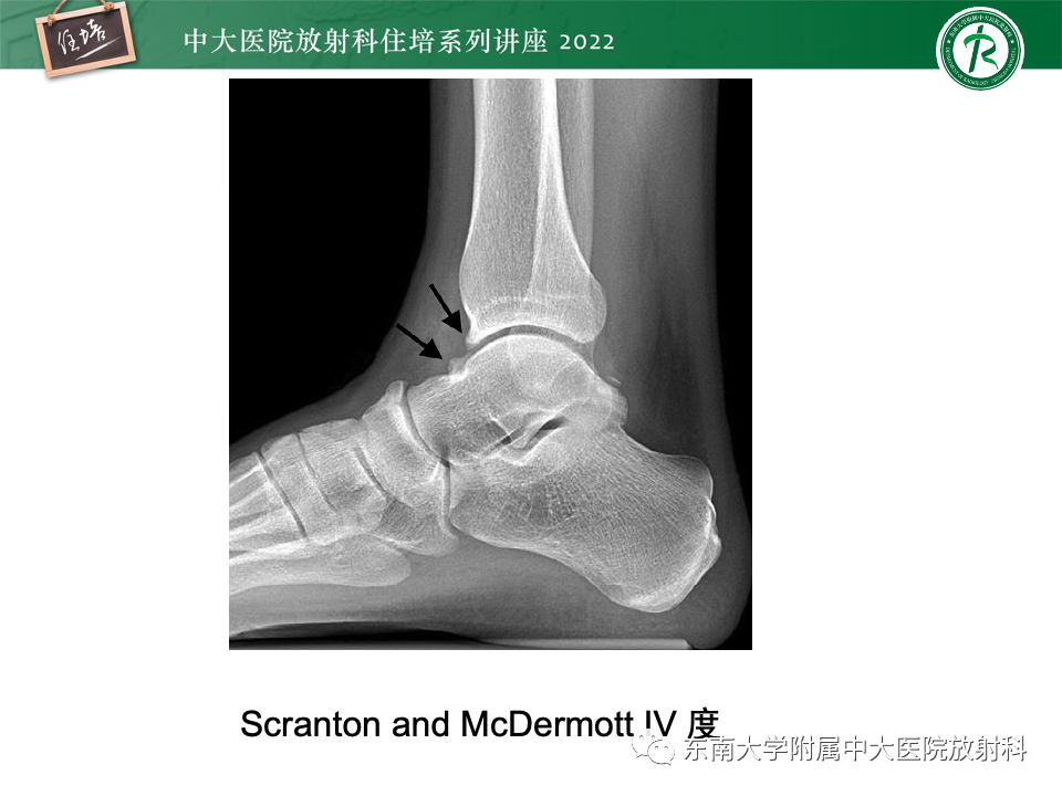 影像PPT - 【PPT】踝关节撞击综合征-14