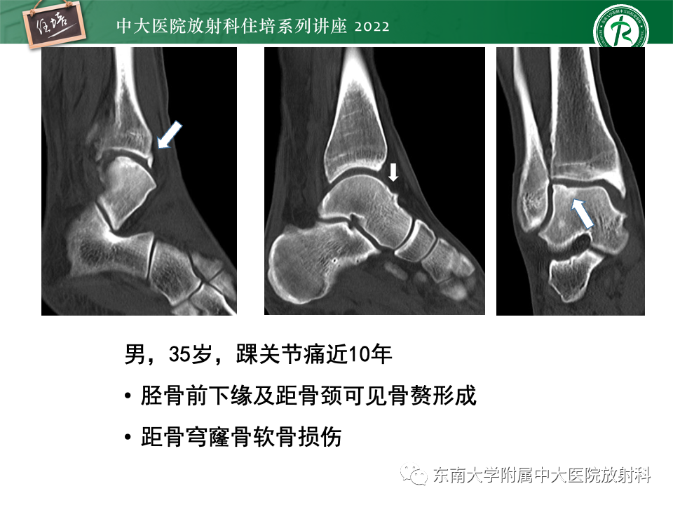 影像PPT - 【PPT】踝关节撞击综合征-15
