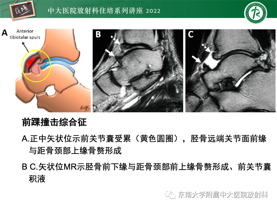 影像PPT - 【PPT】踝关节撞击综合征-16