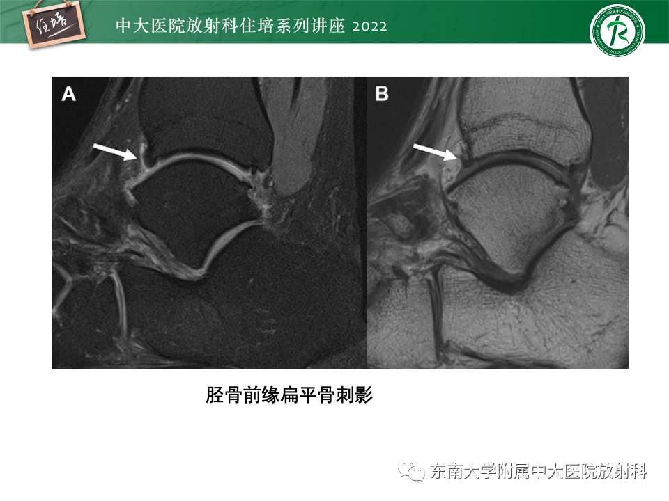 影像PPT - 【PPT】踝关节撞击综合征-17