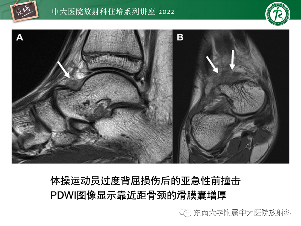 影像PPT - 【PPT】踝关节撞击综合征-18