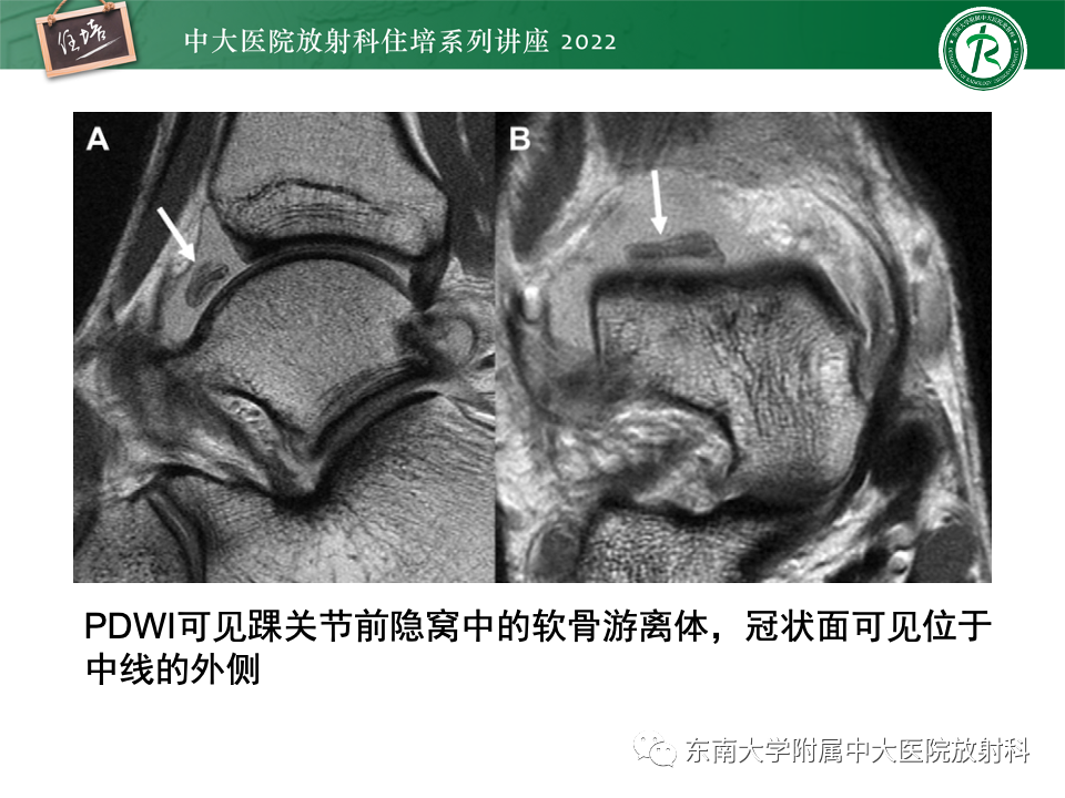 影像PPT - 【PPT】踝关节撞击综合征-19