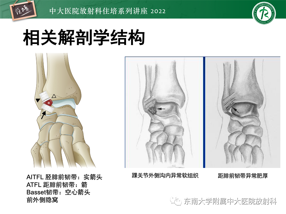 影像PPT - 【PPT】踝关节撞击综合征-22