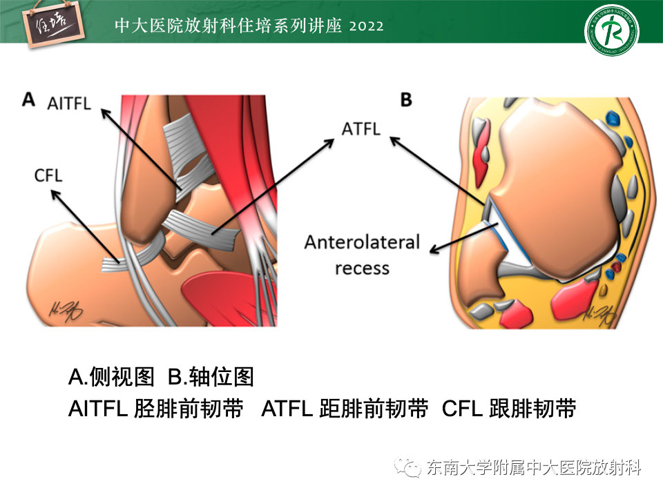 影像PPT - 【PPT】踝关节撞击综合征-23
