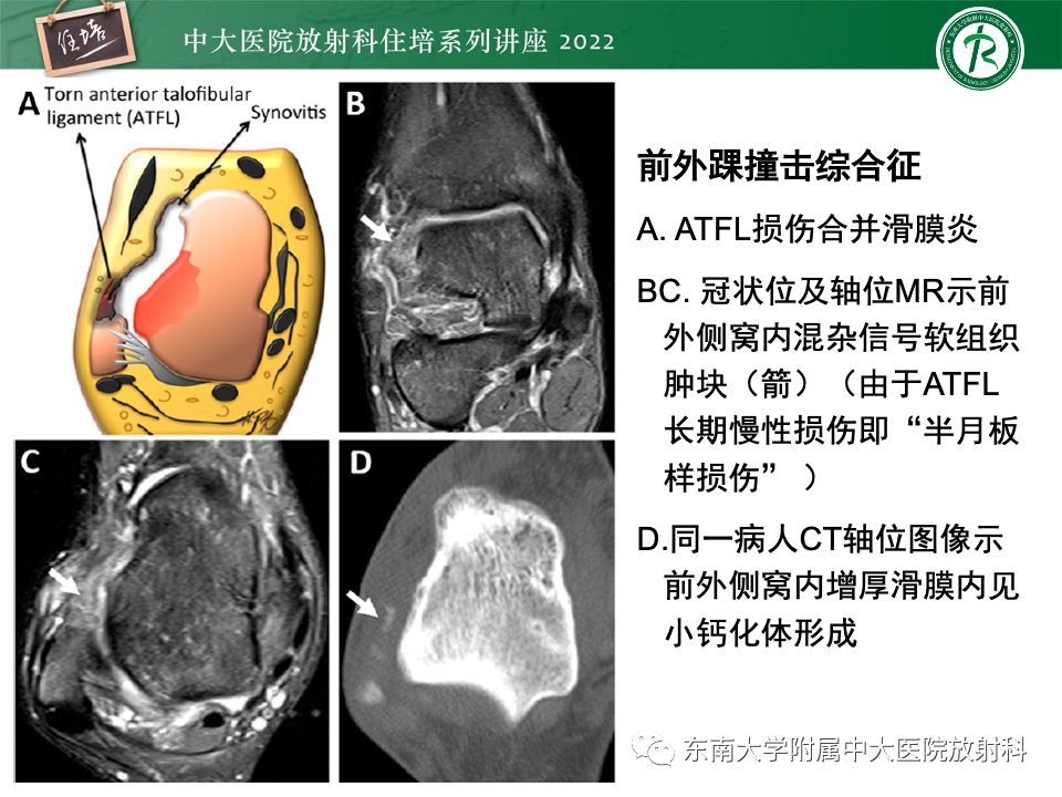 影像PPT - 【PPT】踝关节撞击综合征-26