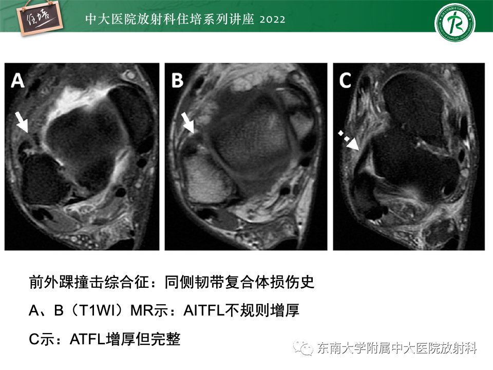 影像PPT - 【PPT】踝关节撞击综合征-27