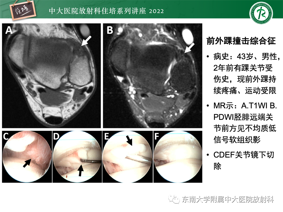 影像PPT - 【PPT】踝关节撞击综合征-28