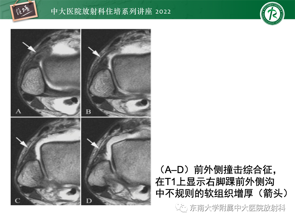 影像PPT - 【PPT】踝关节撞击综合征-29