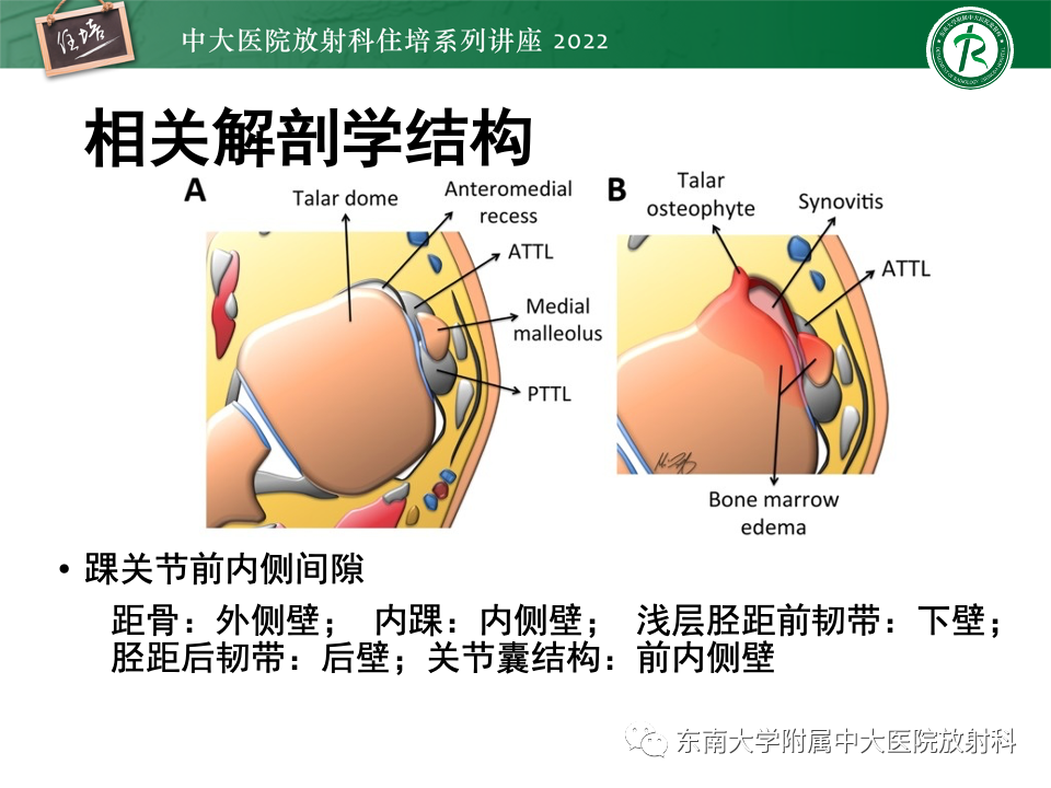 影像PPT - 【PPT】踝关节撞击综合征-32