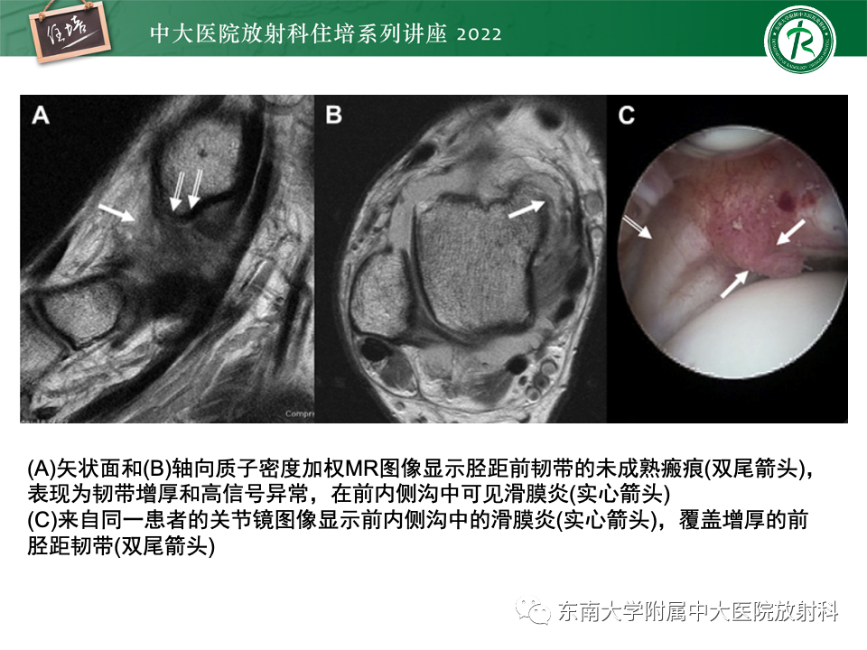 影像PPT - 【PPT】踝关节撞击综合征-35