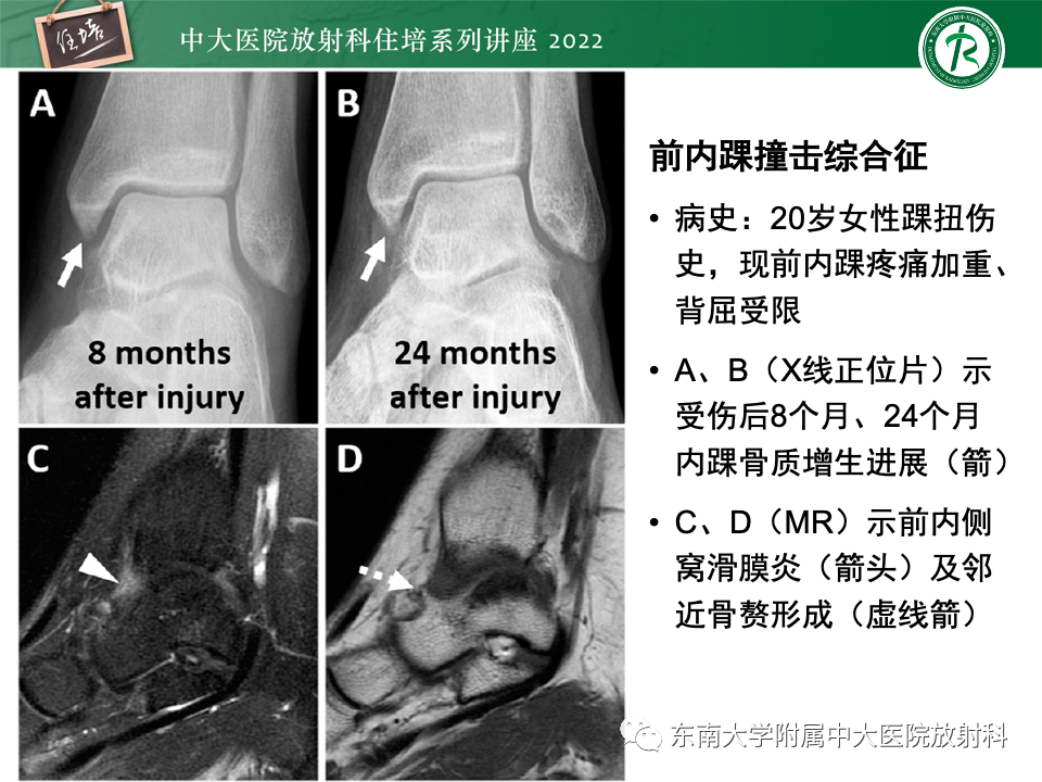 影像PPT - 【PPT】踝关节撞击综合征-36