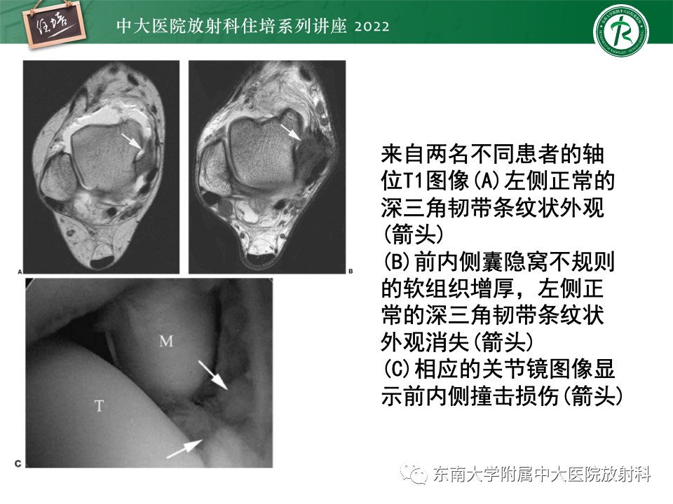 影像PPT - 【PPT】踝关节撞击综合征-37