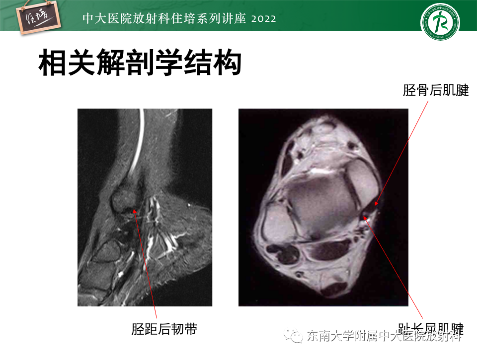 影像PPT - 【PPT】踝关节撞击综合征-41