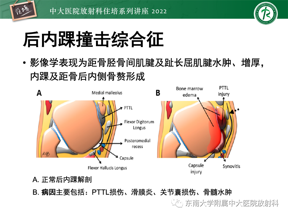 影像PPT - 【PPT】踝关节撞击综合征-42