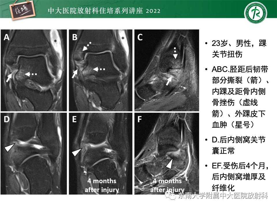 影像PPT - 【PPT】踝关节撞击综合征-45