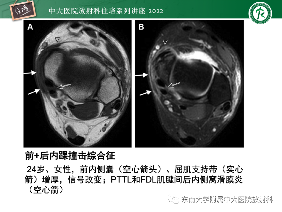 影像PPT - 【PPT】踝关节撞击综合征-46