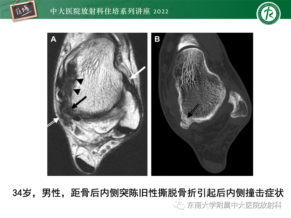 影像PPT - 【PPT】踝关节撞击综合征-47