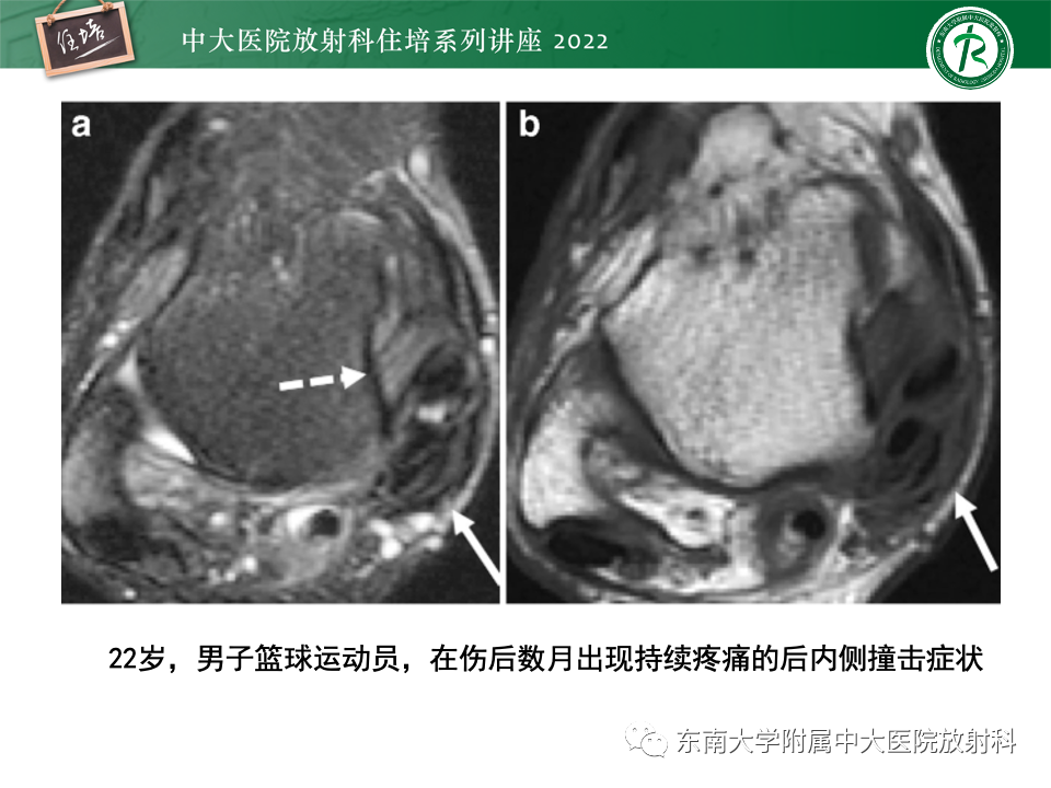 影像PPT - 【PPT】踝关节撞击综合征-48