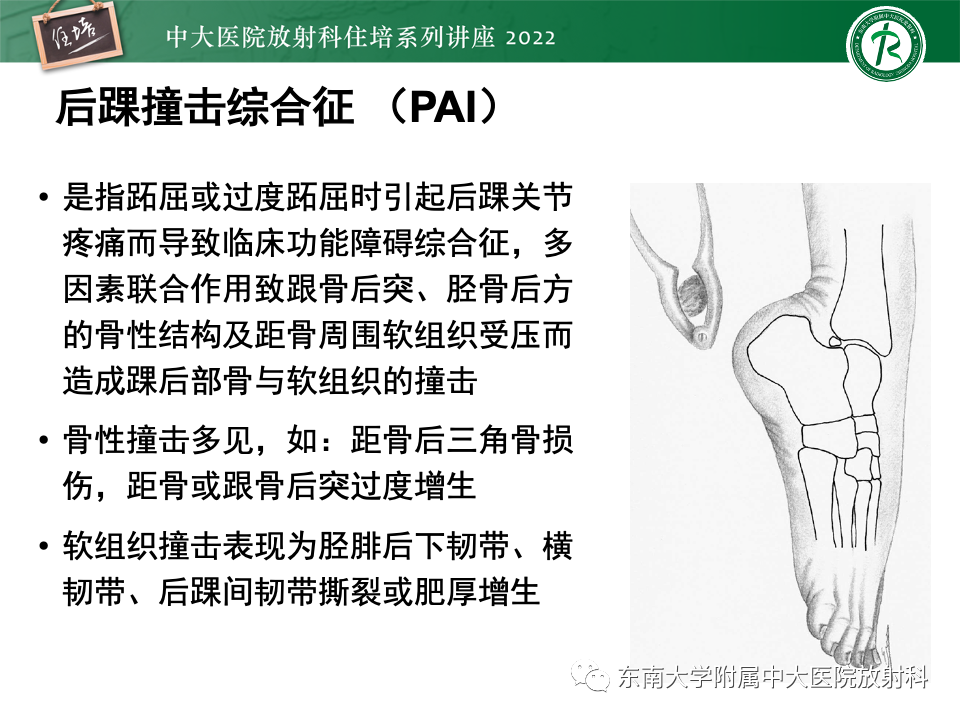 影像PPT - 【PPT】踝关节撞击综合征-50