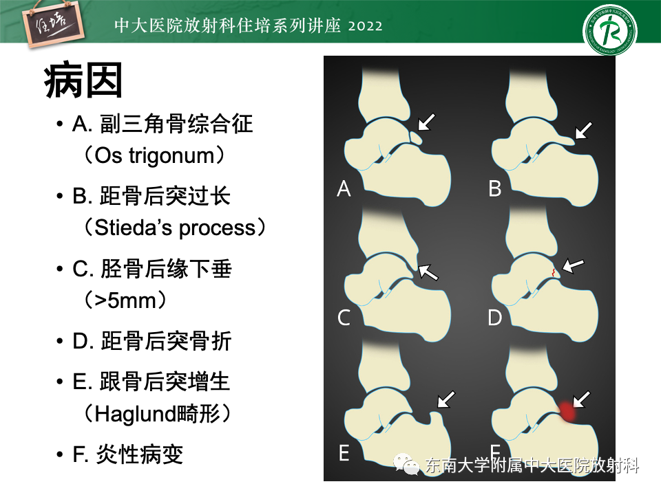 影像PPT - 【PPT】踝关节撞击综合征-51