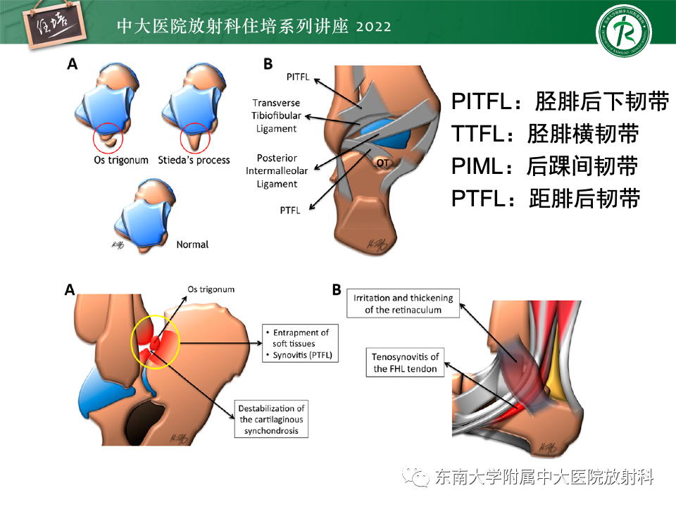 影像PPT - 【PPT】踝关节撞击综合征-52