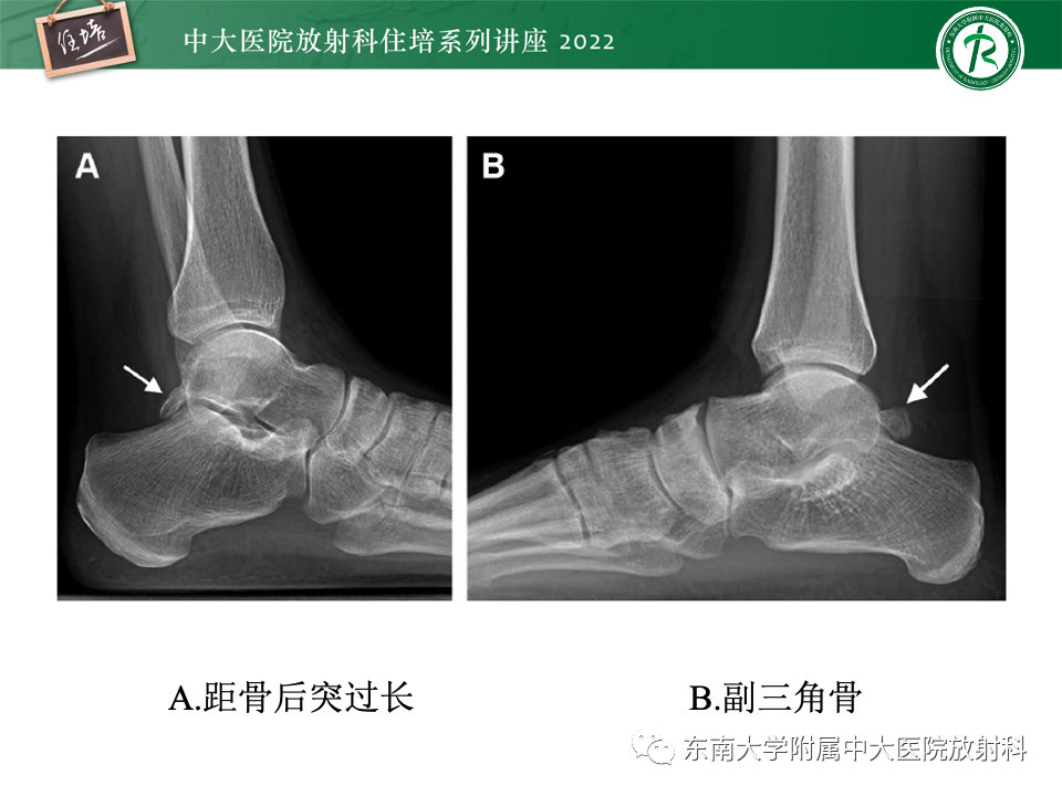 影像PPT - 【PPT】踝关节撞击综合征-55