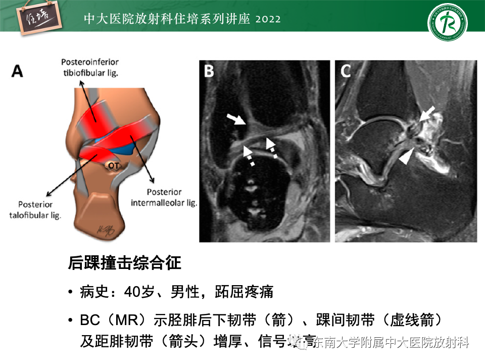 影像PPT - 【PPT】踝关节撞击综合征-56