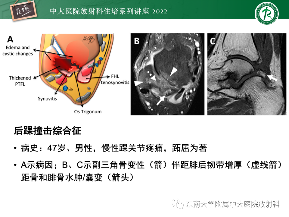 影像PPT - 【PPT】踝关节撞击综合征-57