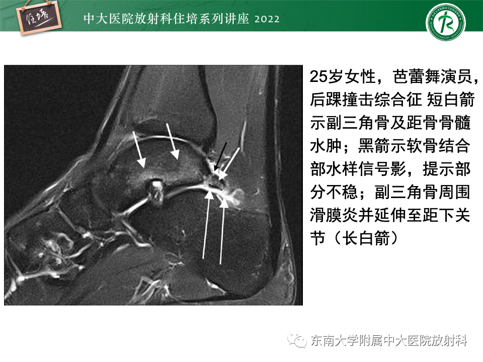 影像PPT - 【PPT】踝关节撞击综合征-58