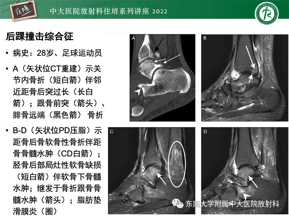 影像PPT - 【PPT】踝关节撞击综合征-59