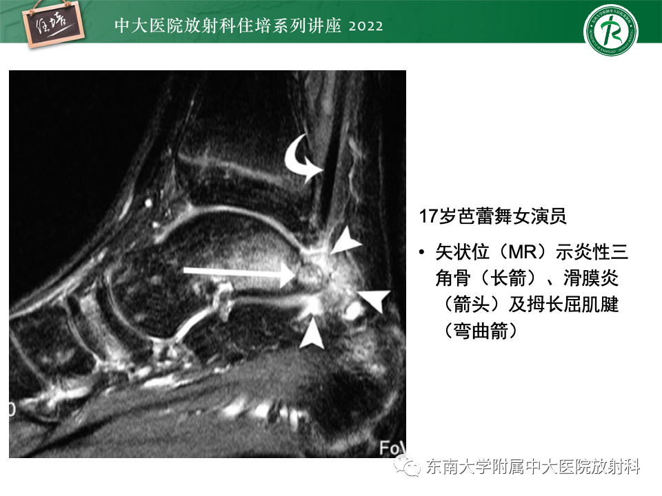 影像PPT - 【PPT】踝关节撞击综合征-60
