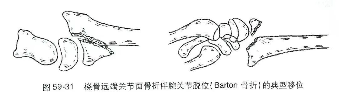 影像PPT - 腕部的“银叉征”-8
