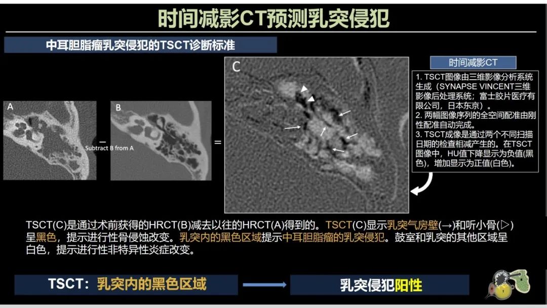 影像PPT - 【PPT】影像学方法术前预测中耳胆脂瘤的乳突侵犯-7