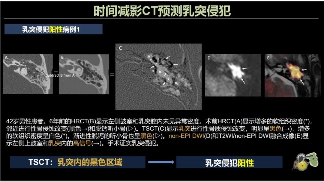 影像PPT - 【PPT】影像学方法术前预测中耳胆脂瘤的乳突侵犯-9