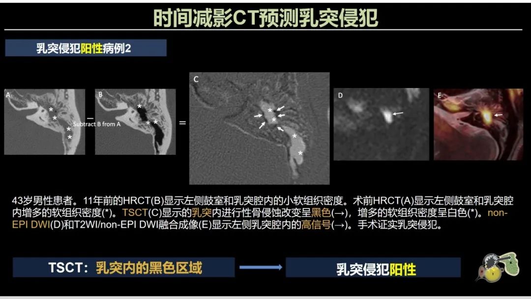 影像PPT - 【PPT】影像学方法术前预测中耳胆脂瘤的乳突侵犯-11