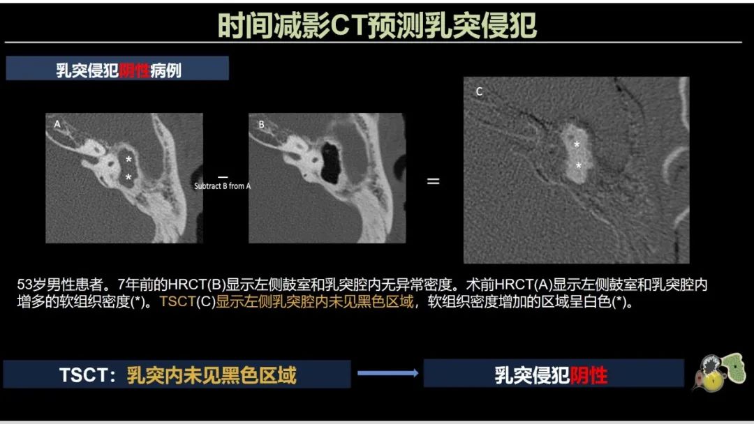 影像PPT - 【PPT】影像学方法术前预测中耳胆脂瘤的乳突侵犯-13