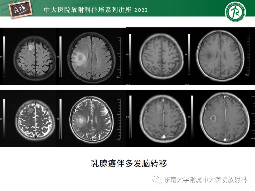影像PPT - 【PPT】影像急诊易漏诊病变总结-10