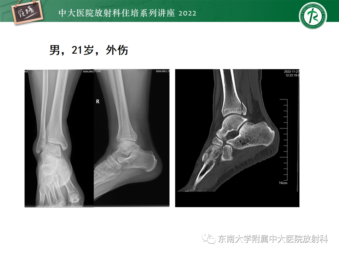 影像PPT - 【PPT】影像急诊易漏诊病变总结-13