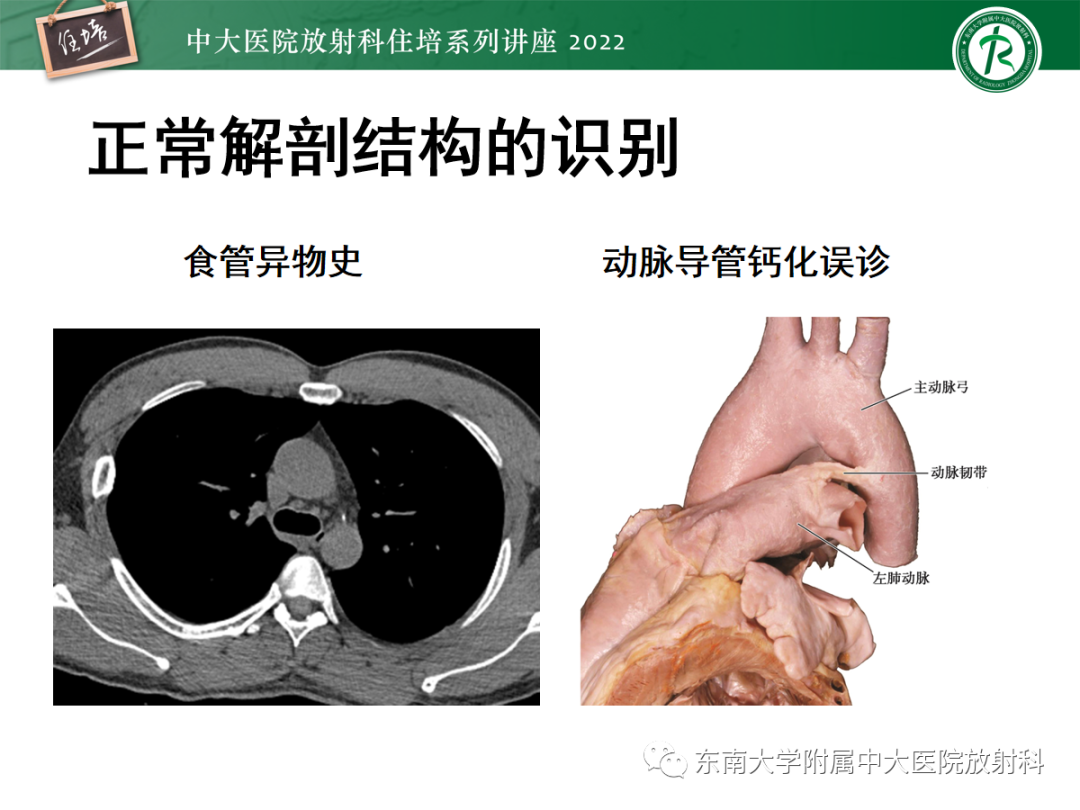 影像PPT - 【PPT】影像急诊易漏诊病变总结-14