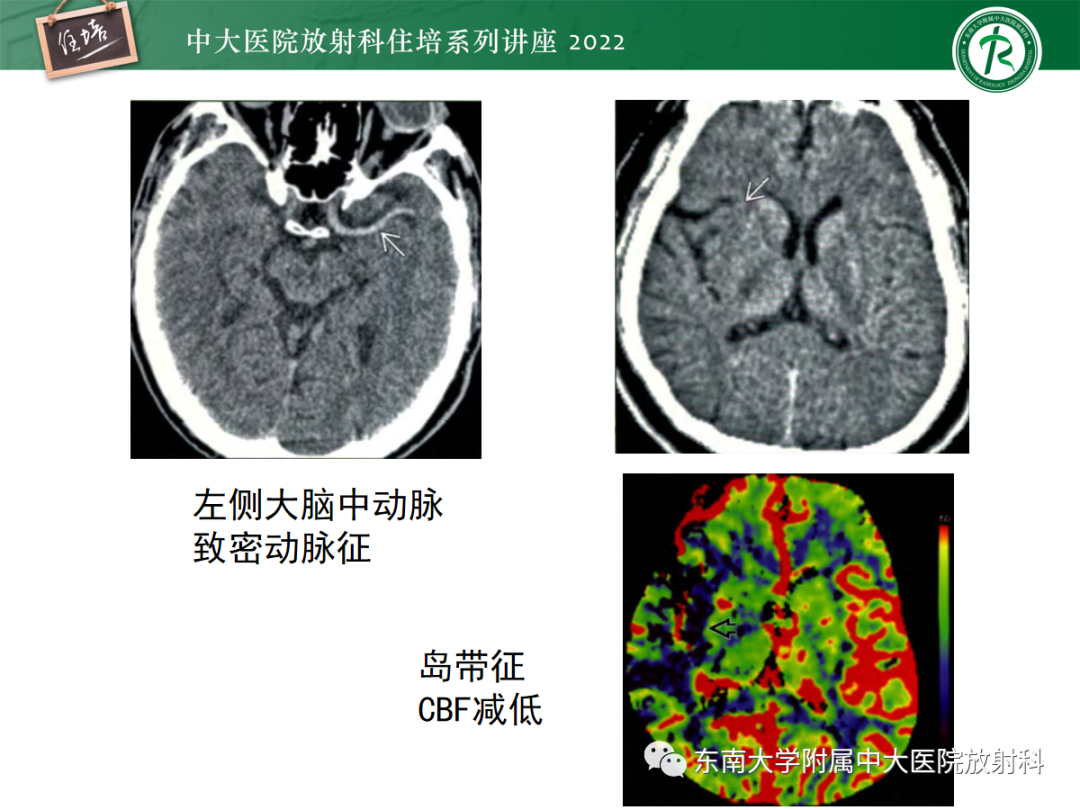 影像PPT - 【PPT】影像急诊易漏诊病变总结-19
