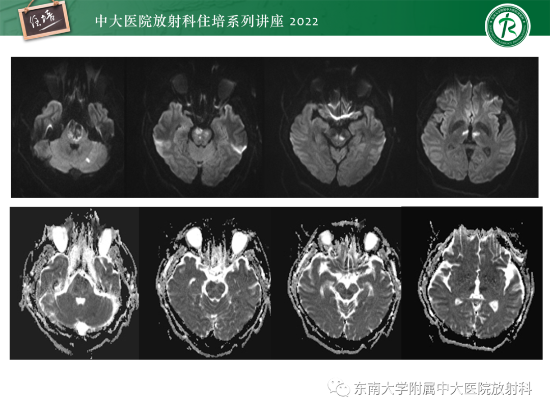 影像PPT - 【PPT】影像急诊易漏诊病变总结-21