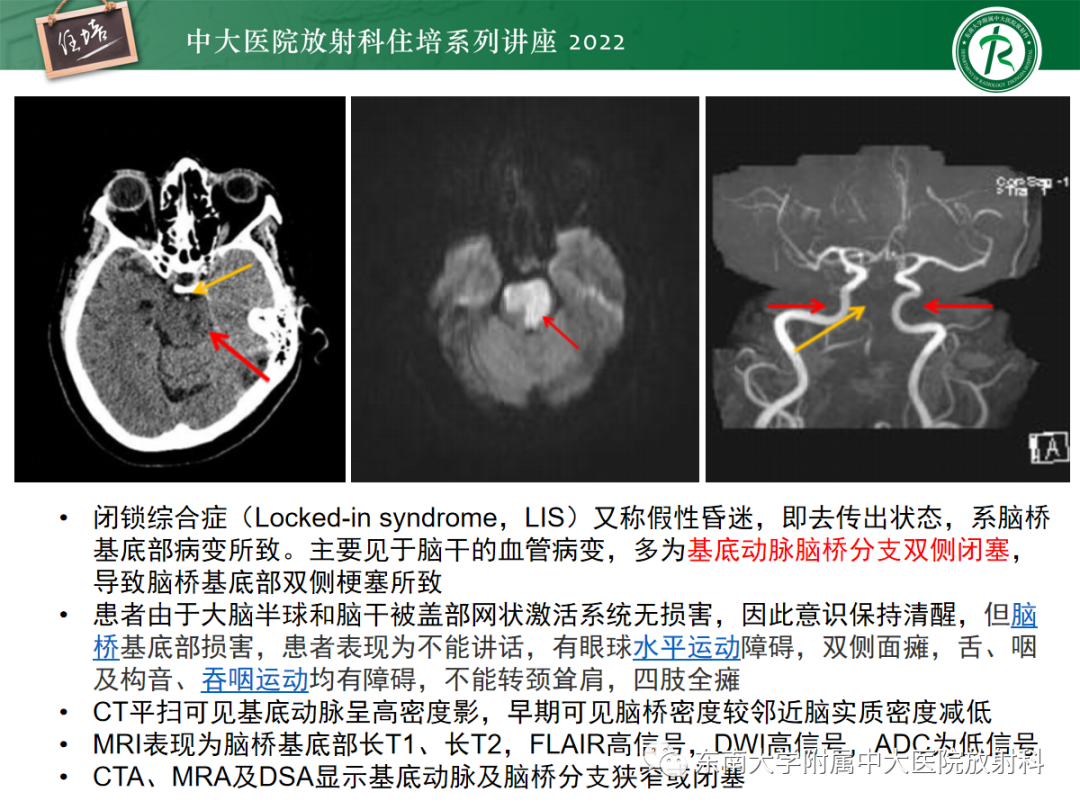 影像PPT - 【PPT】影像急诊易漏诊病变总结-24