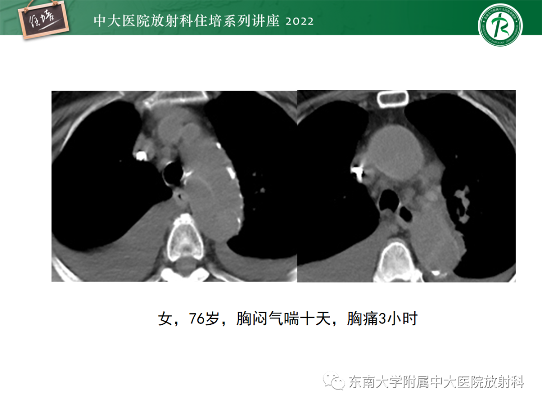 影像PPT - 【PPT】影像急诊易漏诊病变总结-28