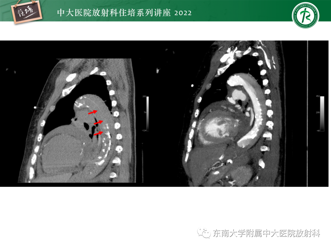 影像PPT - 【PPT】影像急诊易漏诊病变总结-30