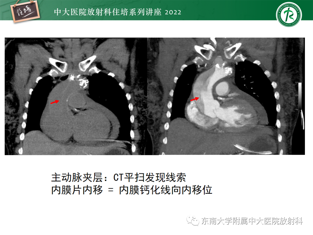 影像PPT - 【PPT】影像急诊易漏诊病变总结-29