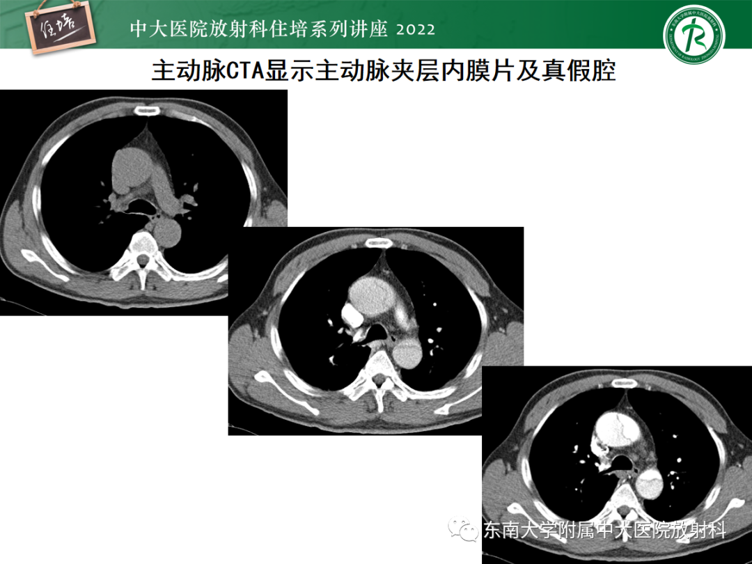 影像PPT - 【PPT】影像急诊易漏诊病变总结-32