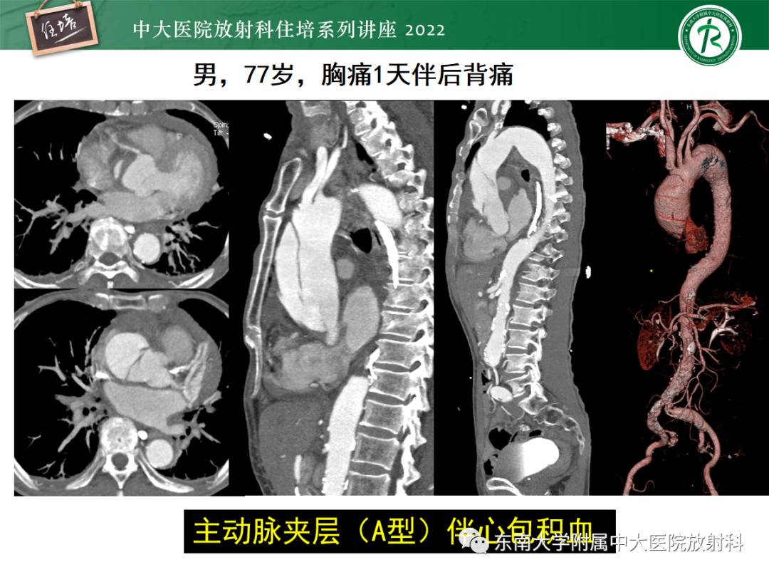 影像PPT - 【PPT】影像急诊易漏诊病变总结-33