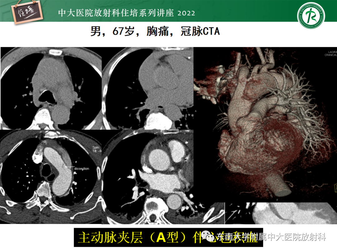 影像PPT - 【PPT】影像急诊易漏诊病变总结-34